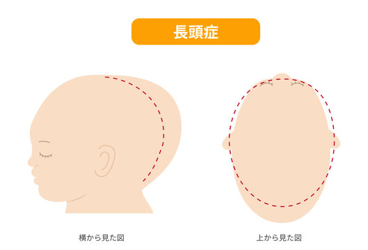 長頭症、横と真上から見た頭の形に歪みがある長頭症の赤ちゃんのイラスト