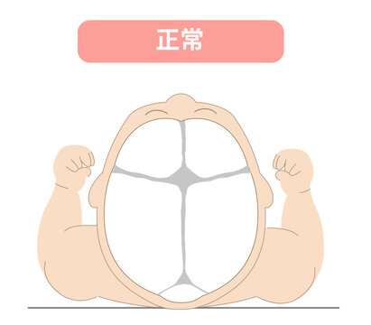 正常な寝方の赤ちゃんのイラスト　赤ちゃんが寝ている際の頭の向きによって頭の形に歪みが生じるメカニズム