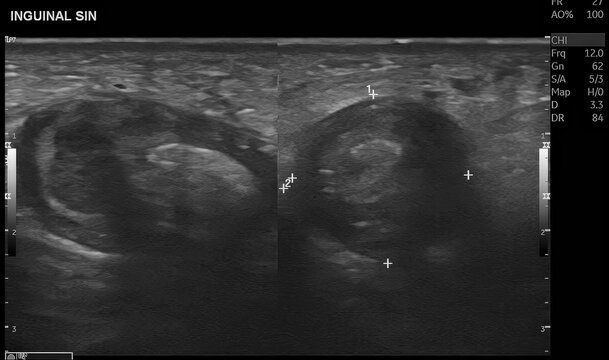 Scrotal ultrasound with color Doppler evaluation demonstrates features suggestive of inguinoscrotal hernia with associated vascular compromise, raising suspicion for testicular torsion. Doppler assess