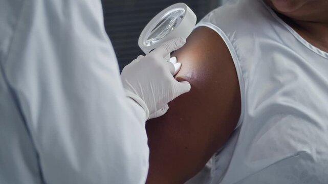 Closeup with selective focus of medical specialist wearing gloves using magnifier to assess Black female patient shoulder during dermatology consultation