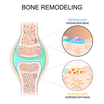 Bone remodeling. Osteoblasts that Synthesize bone tissue, and Osteoclast removes bone tissue.