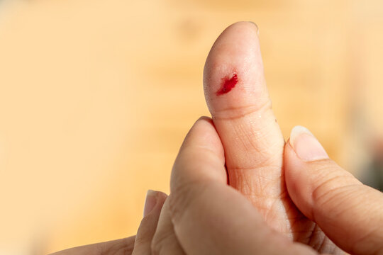 Tiny cut on fingertip, Close up injured thumb with bleeding skin, splinter wound on finger detail, painful hand injury, medical first aid, hygiene awareness, personal care, everyday accident
