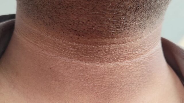 Close-up of acanthosis nigricans medical condition on human neck skin
