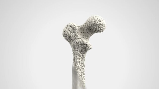 Osteoporosis Bone Structure 3D Medical Animation