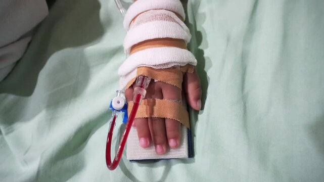 Toddler's hand on IV drip. Blood is visible on the tube. Children with hand fever patients must be given an IV line in the hospital. Concept of leukemia coma due to Cancer, Pediatrics, Dengue fever. 