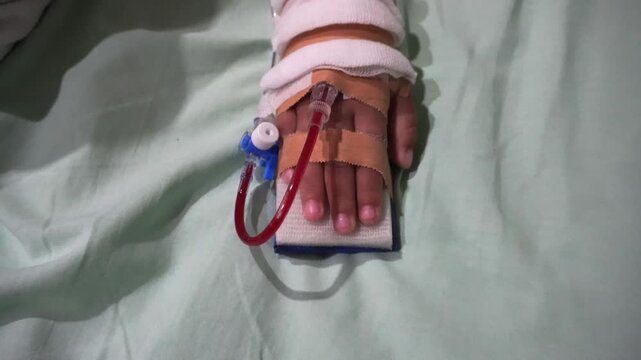 Toddler's hand on IV drip. Blood is visible on the tube. Children with hand fever patients must be given an IV line in the hospital. Concept of leukemia coma due to Cancer, Pediatrics, Dengue fever. 