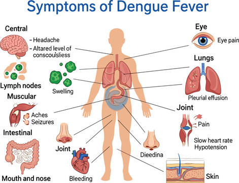Symptoms of Dengue Fever Medical Infographic