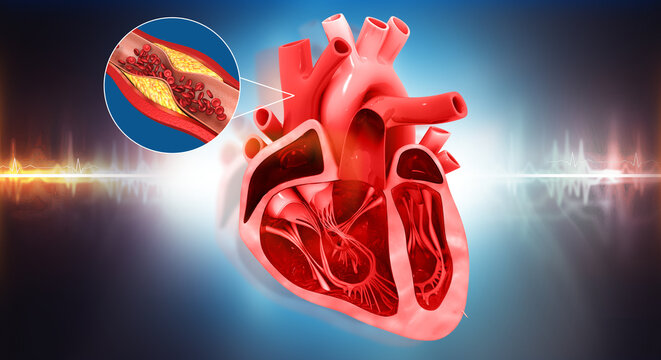 Detailed 3D medical cross-section of a human heart showing internal chambers and a severely clogged artery with cholesterol plaque buildup.
