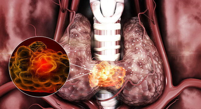 Detailed 3D anatomical model of the human thyroid gland and larynx featuring a localized tumor growth to illustrate endocrine pathology.