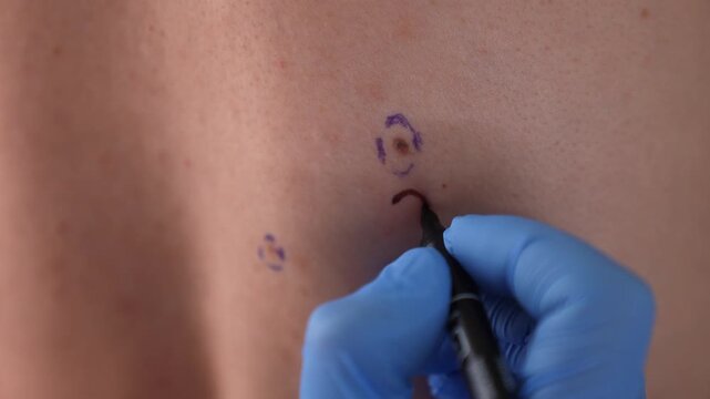 A dermatologist wearing blue gloves examines a mole on a hairy male torso and draws a question mark with a marker, during a skin cancer screening and plastic surgery consultation.