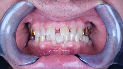 Obraz premium Closeup of a woman's mouth with dental braces and metal braces.