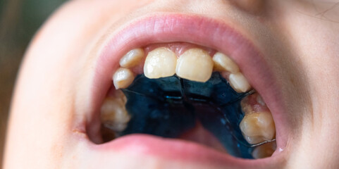 Open mouth, view of plate on upper jaw, orthodontic appliance for expansion and bite correction in child. © Ольга Симонова