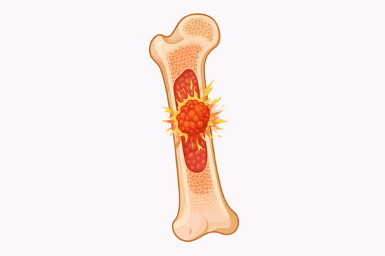 Illustration of a bone with a tumor growing inside the marrow cavity
