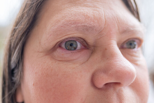 female eye with visible redness, severe swelling, periorbital edema, inflammatory process, allergic, infectious eye condition, ocular inflammation and trauma, ophthalmology blepharitis, conjunctivitis