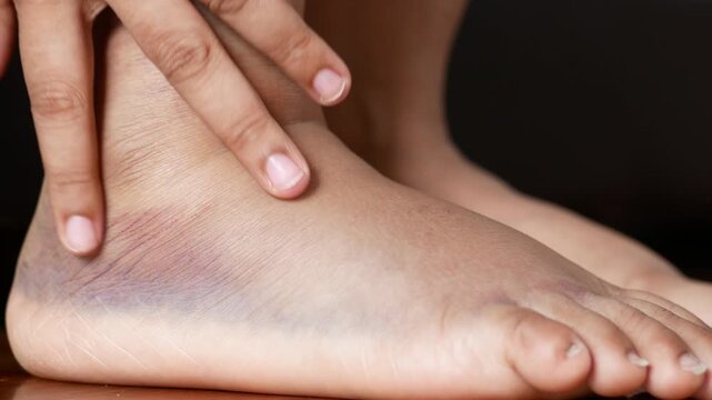 Bruised and swollen human ankle and foot showing inflammation from injury or sprain with medical examination