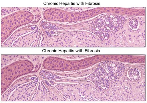 Microscopic view of chronic hepatitis showing liver cell damage and fibrous tissue formation