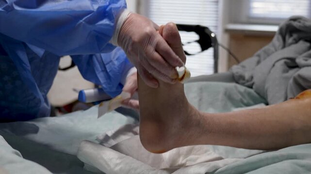 Doctor Cleaning Diabetic Foot Ulcer with Sterile Gauze. Medical Treatment of Chronic Diabetic Foot Wound. Diabetes treatment