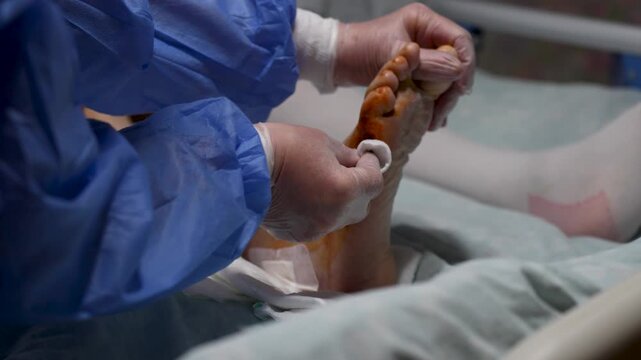Doctor Cleaning Diabetic Foot Ulcer with Sterile Gauze. Medical Treatment of Chronic Diabetic Foot Wound. Diabetes treatment