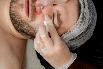 Cosmetologist uses comedone extractor to thoroughly remove blackheads for male patient. Facial procedure and treatment in dermatology or aesthetic clinic 