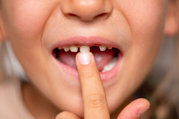 Naklejka premium Child showing loose baby tooth with finger pointing at it, mouth open, revealing gap between teeth, close-up view of dental situation and oral health