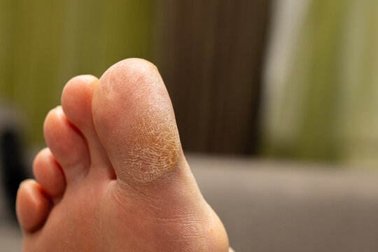 Close-up view of the flaky and thickened skin layer on the toe. High-quality image suitable for content related to skin diseases, eczema, or callus treatment.
