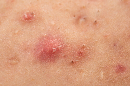 Inflamed skin bumps acne macro. Macro shot of skin irritation with acne. Detailed skin with acne. Close up acne on skin.