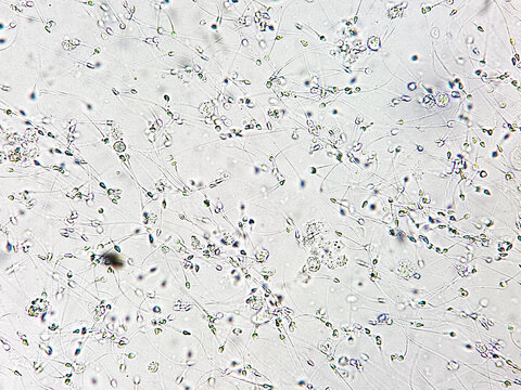 Sperm analysis on microscopic examination, Normozoospermia.