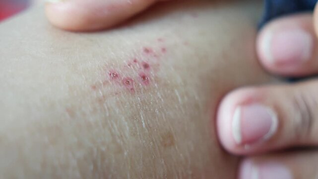 Close up video shows red pimples on human skin from an allergic reaction, mosquito bites, or another skin condition