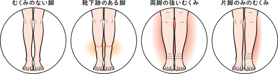 脚のむくみの症状比較（靴下跡・両脚むくみ・片脚のみ）