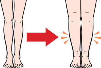 むくみのない脚からむくみのある脚への変化