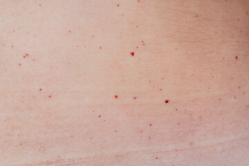 Fototapeta premium Multiple red dots or moles on the body or senile angiomas