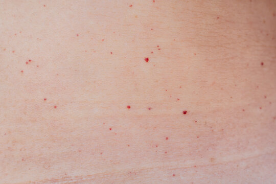 Multiple red dots or moles on the body or senile angiomas