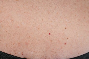Fototapeta premium Multiple red dots or moles on the body or senile angiomas