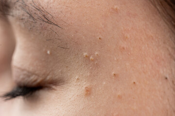 Acne on epidermis with follicles and bumps. Skincare concept for acne with inflammation. Detail of acne with comedone and pores. Derma dermatology for acne and irritation.