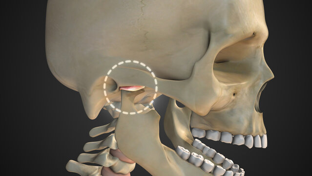 Temporomandibular Joint Disorder Causing Severe Jaw Pain
