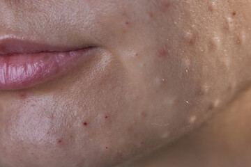 Fototapeta premium Injectable cosmetology. Facial biorevitalization procedure using a hyaluronic acid-based product. Papules on female face after biorevitalization. close-up