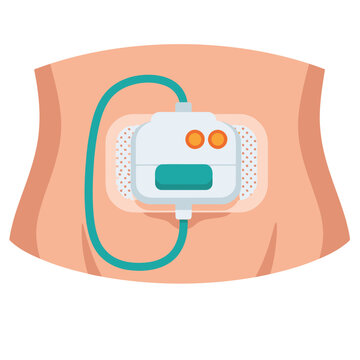 Illustration depicts an insulin pump patch on a person's abdomen, highlighting diabetes management. Clean, modern design with clear labeling. Suitable for health and wellness visuals.