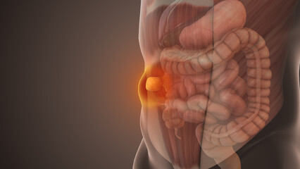 Epigastric Hernia Bulge in Abdominal Wall © Shashikala