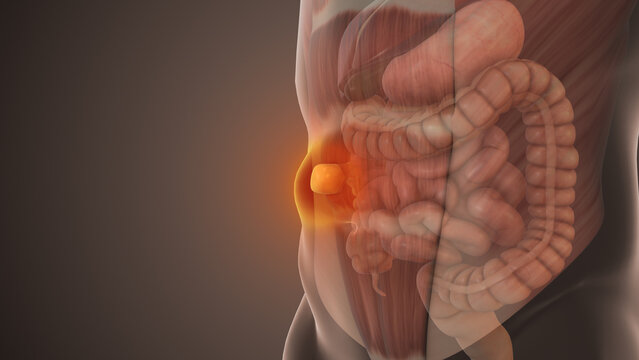 Epigastric Hernia Bulge in Abdominal Wall