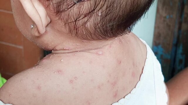 The Molluscum contagiosum virus causes a skin condition that results in rashes and bumps. The environment plays a major role, but direct skin-to-skin contact remains the primary route of transmission.