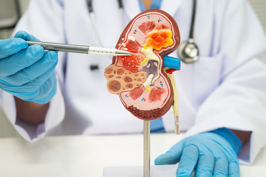 Chronic kidney disease, doctor with model for treatment urinary system.