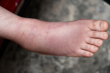 Swollen Foot After Cast Removal of Metatarsal Fracture