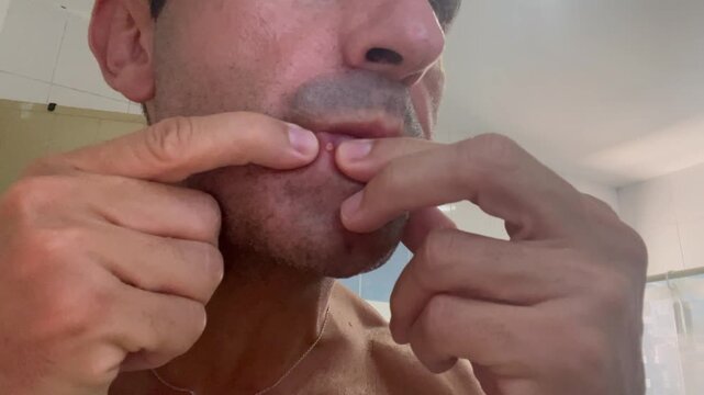 Close-up of an adult man squeezing a pimple on his lower lip in a bathroom, showing skin care, acne treatment, and personal hygiene in a real-life, unfiltered moment