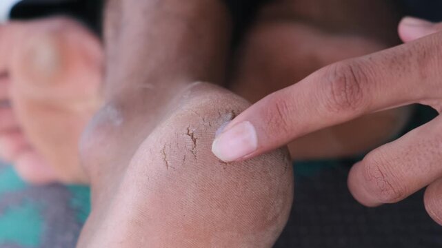 Close-up of a person applying healing cream or moisturizer to a dry, cracked heel for skin treatment