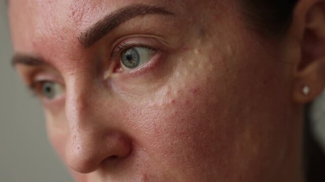 Injection marks on the face of a woman after biorevitalization treatment. 4K