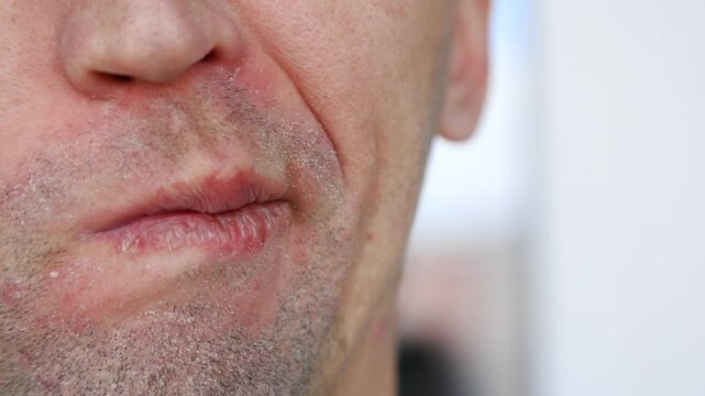 A man inspects his irritated, flaky skin and chapped lips after acne treatment. This footage highlights dry skin concerns, skincare routines, and post-shave care for grooming enthusiasts.