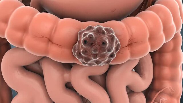 Medical animation showing the progression of colorectal cancer in the human large intestine. Anatomical visualization of a malignant tumor for oncology and science education