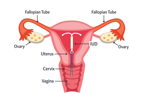 Female anatomy with intrauterine device placement, highlighting IUD birth control and contraception for women's health