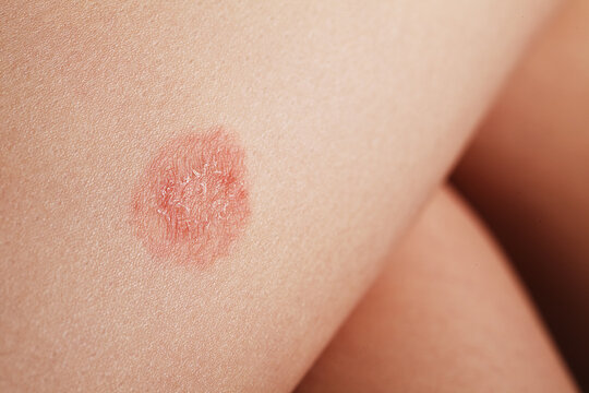 Detailed Skin Problem. Rosea, Highresolution Image Emphasizing Skin Irregularities And Rashes Distinctly. Closeup Shot Revealing Detailed Skin Lesions And Surface Irregularities With Magnification