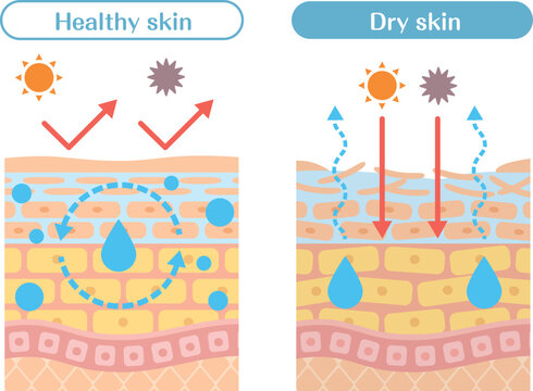 Dry skin structure diagram comparison